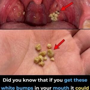 Tonsil Stones Explained