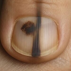 Aggressive Skin Tumor Warning