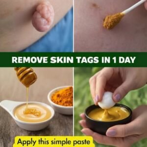 Best Natural Home Remedies To Safely Remove Skin Tags