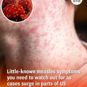 Little-known measles symptoms you need to watch out for as cases surge in parts of US