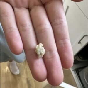 Here’s what you need to know about tonsil stones – the weird pimple-like growths in your throat