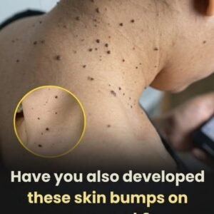 Why Skin Tags Appear