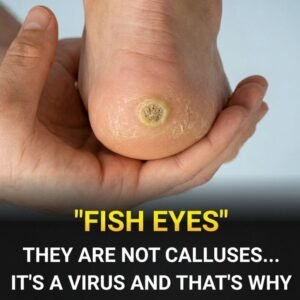 Plantar Warts on the Feet: What They Really Are, Why Many People Mistake Them for Ordinary Calluses, and the Important Signs That Reveal the Difference, as Experts Explain the Causes, Hidden Symptoms, and Risks of Ignoring Them, Helping Readers Understand When a Simple Foot Problem May Actually Require Proper Medical Attention