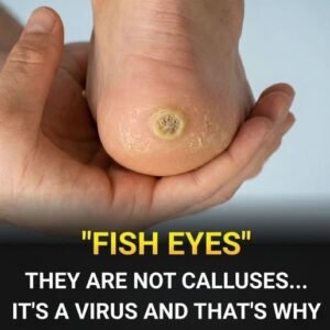 Plantar Warts Explained