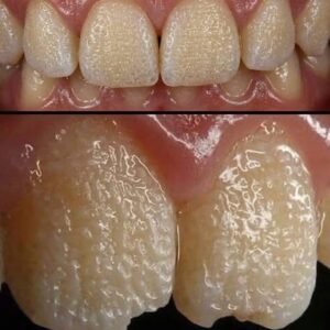 Be Careful! This Is What Can Happen to Your Teeth When You Eat Certain Everyday Foods and Drinks That Slowly Damage Enamel, Cause Staining, Increase Sensitivity, and Lead to Long-Term Dental Problems You Might Not Notice Until It’s Too Late to Reverse the Effects