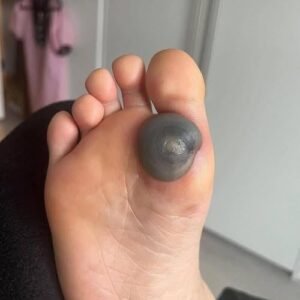 Painful Foot Spot Explained