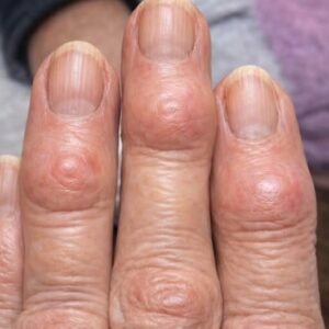 Finger Joint Bumps Explained