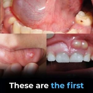Hidden Dangers in Your Mouth — Early Signs of Oral Cancer You Should Never Ignore