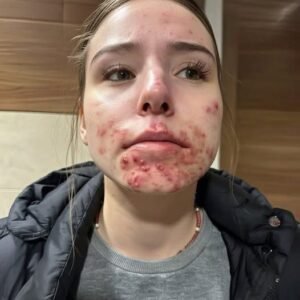 The Hidden Reasons You Keep Getting Pimples on Your Chin