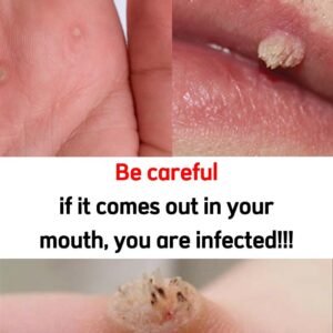 Natural Wart Removal: Simple Methods That Might Actually Work