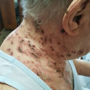 This is the silent disease that is triggered when you come into contact with …