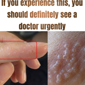 Painful Red Bumps on Your Hands or Feet? It Could Be Dyshidrotic eczema—Experts Explain the Symptoms, Triggers, and Treatment Options, Highlighting How This Skin Condition Can Cause Itching, Blisters, and Discomfort, and Why Early Care, Proper Diagnosis, and Skin Protection Are Important to Manage Flare-Ups and Prevent Recurrence