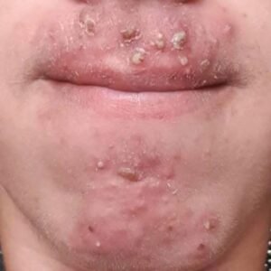 Been dating this woman I met at Walmart and after finally getting some I woke up with these on my face what is this?