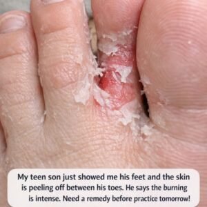 My teen son just showed me his feet and the skin is peeling off between his toes. He says the burning is intense. Need a remedy before practice tomorrow!