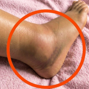 If You Notice Your Legs Are Swollen, Doctors Warn It Could Be a Sign of a Serious Underlying Condition That Many People Overlook Until It Becomes Dangerous. What Seems Like a Simple Change in Your Body May Actually Be Linked to Circulation Problems, Fluid Retention, or Other Health Issues That Should Never Be Ignored Without Proper Medical Attention Immediately