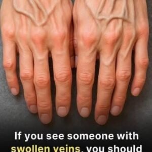 What Do Visible Veins Really Mean? Understanding the Causes and When to Pay Attention